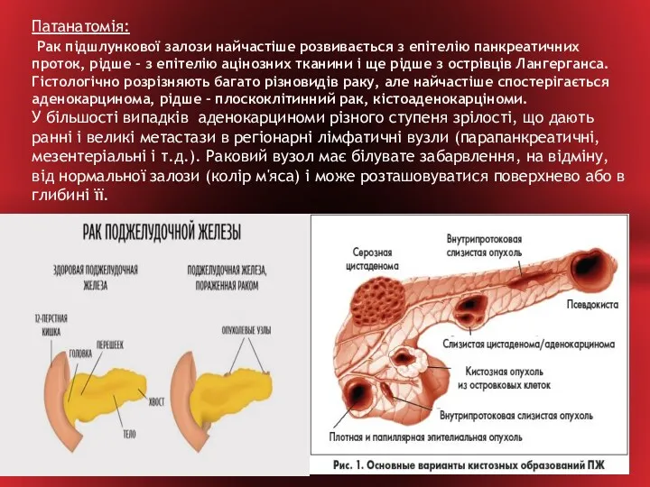 Патанатомія: Рак підшлункової залози найчастіше розвивається з епітелію панкреатичних проток, рідше - з