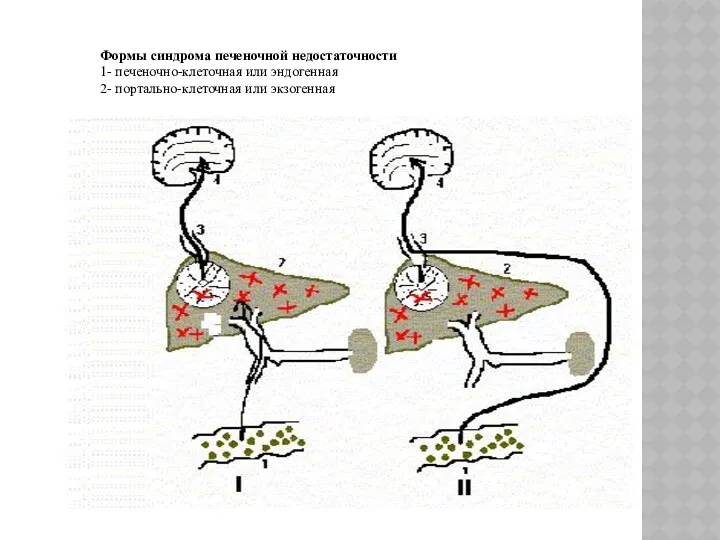 Формы синдрома печеночной недостаточности 1- печеночно-клеточная или эндогенная 2- портально-клеточная или экзогенная