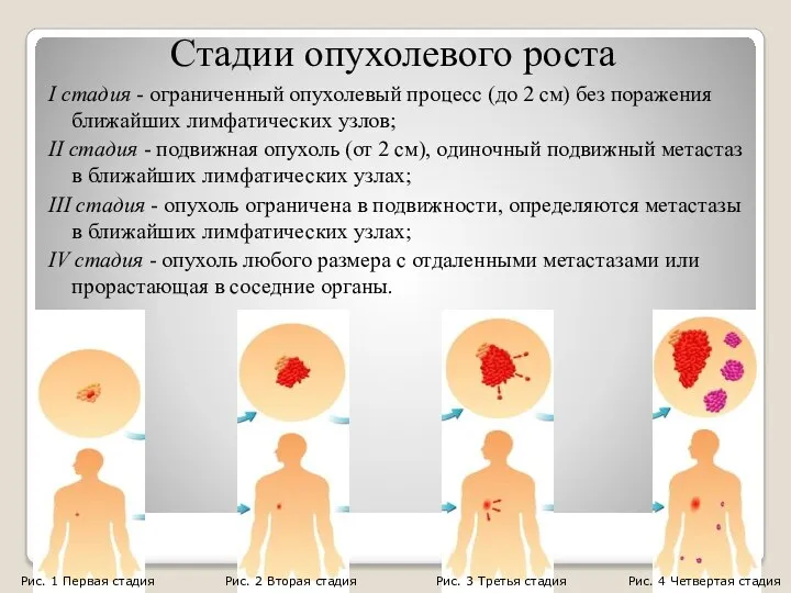 Стадии опухолевого роста I стадия - ограниченный опухолевый процесс (до