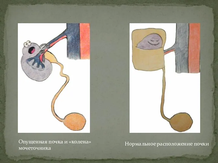 Опущенная почка и «колена» мочеточника Нормальное расположение почки