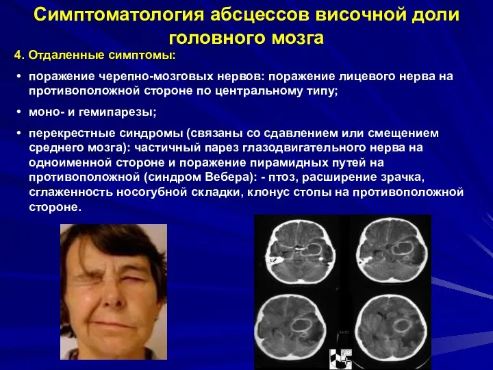 Симптоматология абсцессов височной доли головного мозга 4. Отдаленные симптомы: поражение черепно-мозговых нервов: поражение