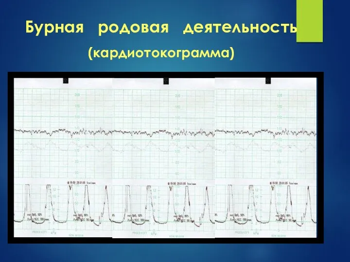 Бурная родовая деятельность (кардиотокограмма)