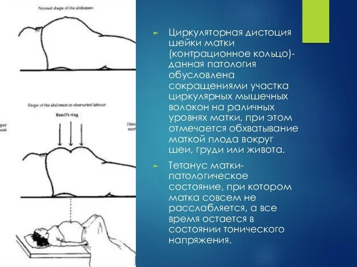 Циркуляторная дистоция шейки матки(контрационное кольцо)- данная патология обусловлена сокращениями участка