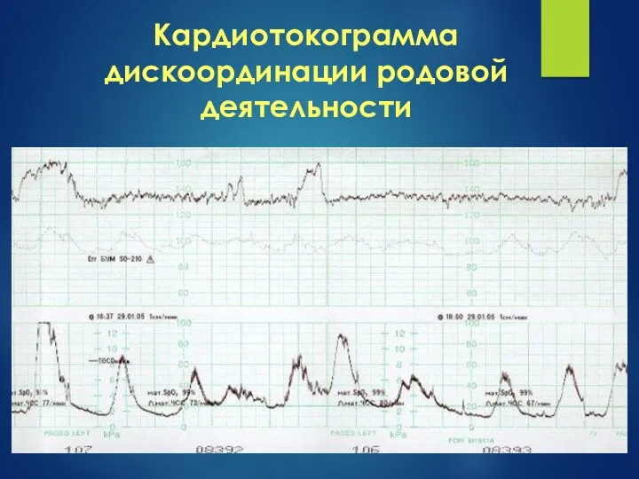 Кардиотокограмма дискоординации родовой деятельности