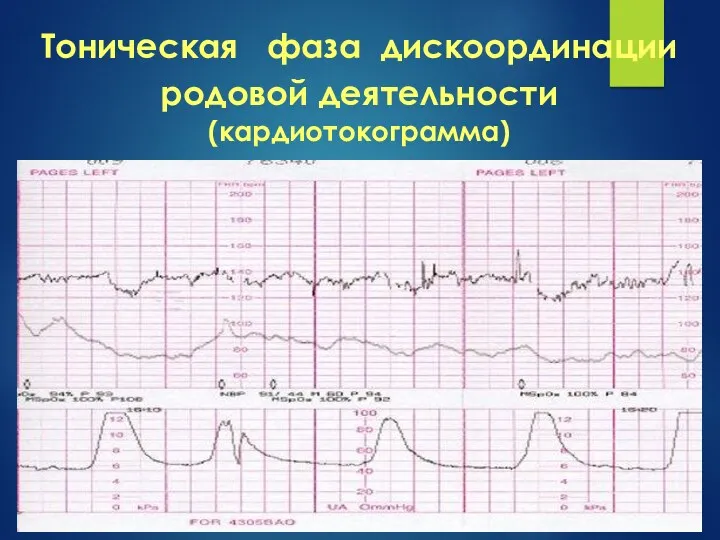 Тоническая фаза дискоординации родовой деятельности (кардиотокограмма)