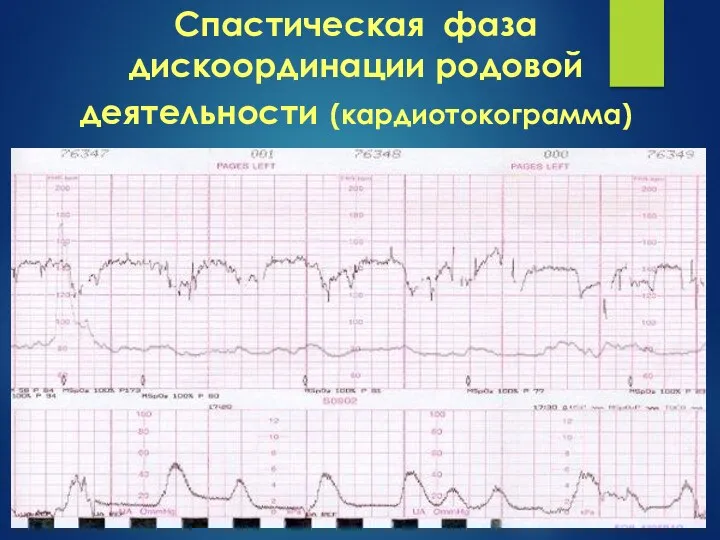 Спастическая фаза дискоординации родовой деятельности (кардиотокограмма)