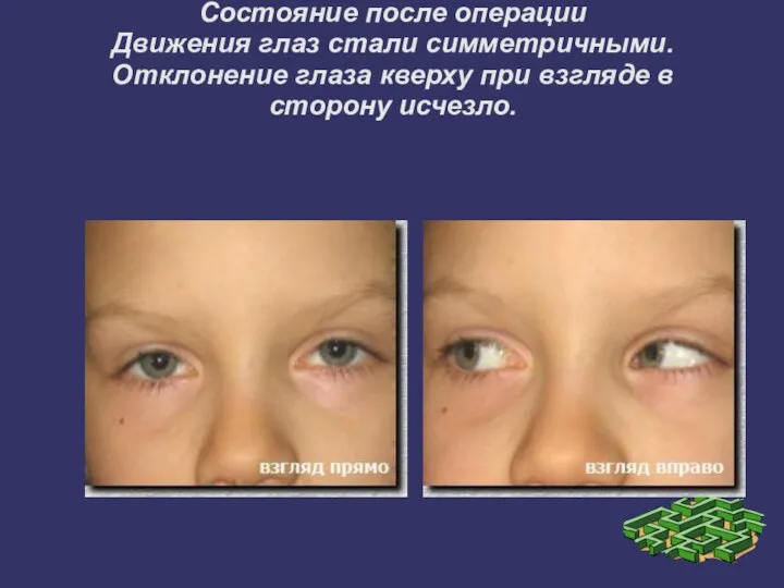 Состояние после операции Движения глаз стали симметричными. Отклонение глаза кверху при взгляде в сторону исчезло.