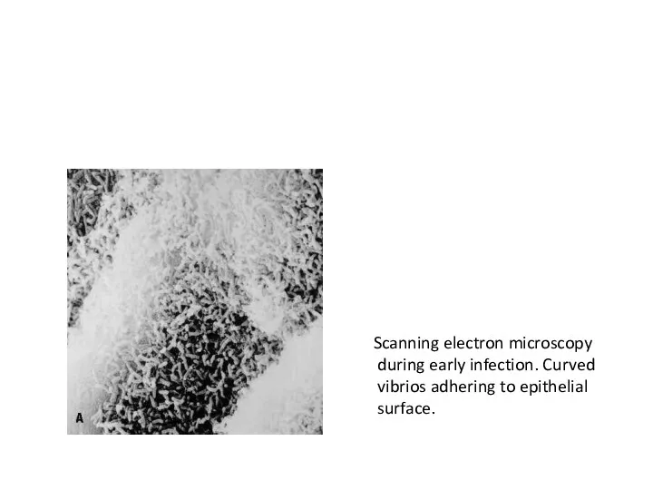 Scanning electron microscopy during early infection. Curved vibrios adhering to epithelial surface. Vibrio