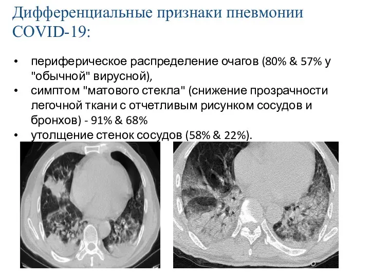 Дифференциальные признаки пневмонии COVID-19: периферическое распределение очагов (80% & 57% у "обычной" вирусной),