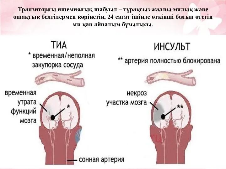 Транзиторлы ишемиялық шабуыл – тұрақсыз жалпы милық және ошақтық белгілермен