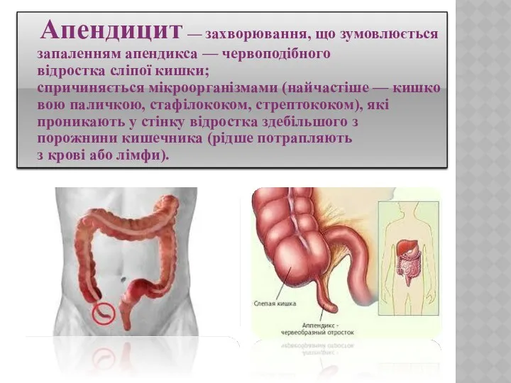 Апендицит — захворювання, що зумовлюється запаленням апендикса — червоподібного відростка