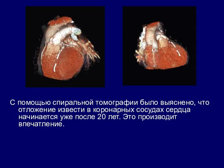 С помощью спиральной томографии было выяснено, что отложение извести в