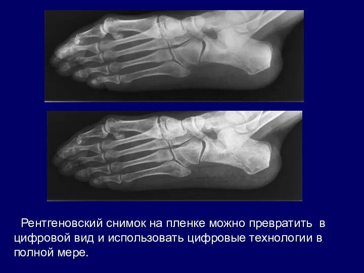 Рентгеновский снимок на пленке можно превратить в цифровой вид и использовать цифровые технологии в полной мере.