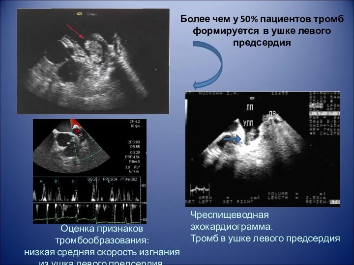 Чреспищеводная эхокардиограмма. Тромб в ушке левого предсердия Более чем у