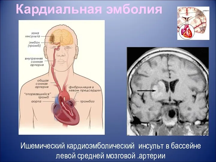 Кардиальная эмболия Ишемический кардиоэмболический инсульт в бассейне левой средней мозговой .артерии