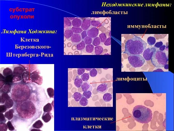 субстрат опухоли Лимфома Ходжкина: Клетка Березовского- Штернберга-Рида Неходжкинские лимфомы: лимфобласты иммунобласты лимфоциты плазматические клетки