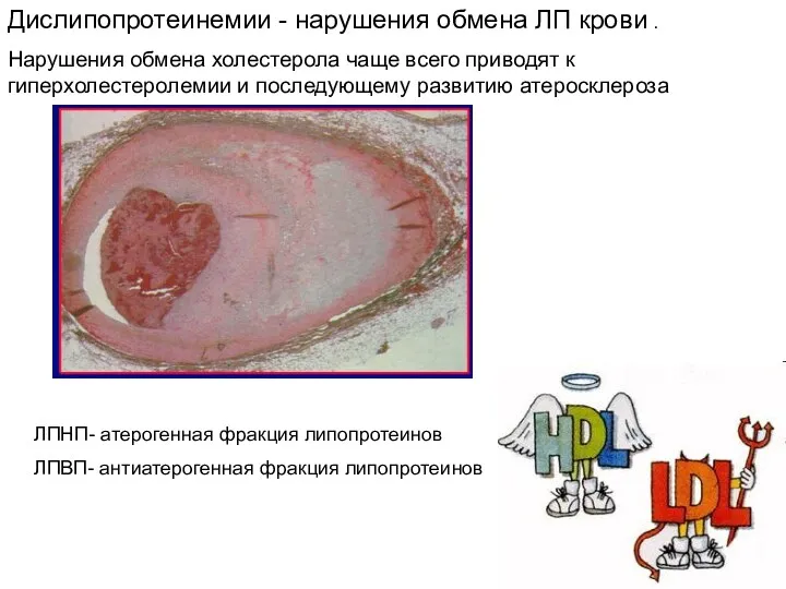 ЛПНП- атерогенная фракция липопротеинов ЛПВП- антиатерогенная фракция липопротеинов Дислипопротеинемии -