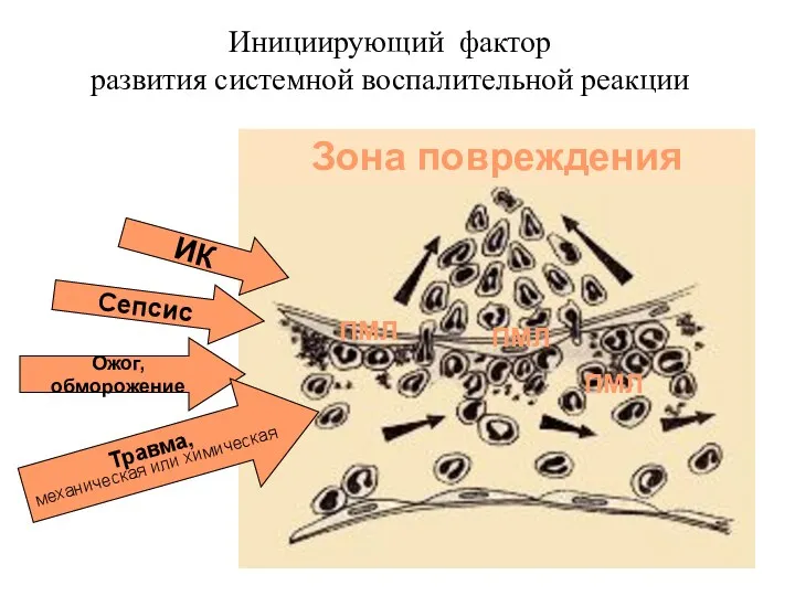 ИК Сепсис Ожог, обморожение Травма, механическая или химическая ПМЛ ПМЛ