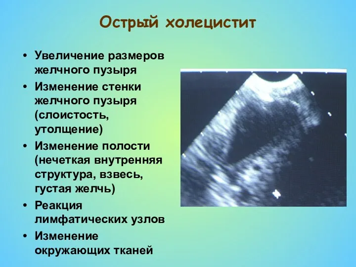 Острый холецистит Увеличение размеров желчного пузыря Изменение стенки желчного пузыря
