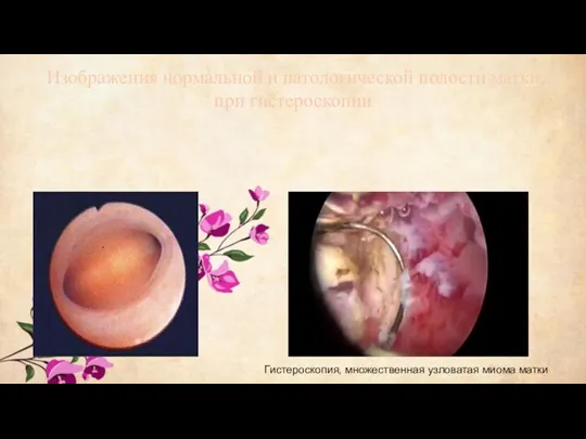 Изображения нормальной и патологической полости матки при гистероскопии Гистероскопия, множественная узловатая миома матки