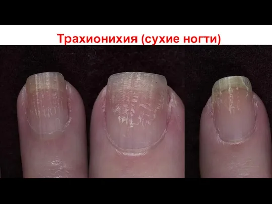 Трахионихия (сухие ногти)