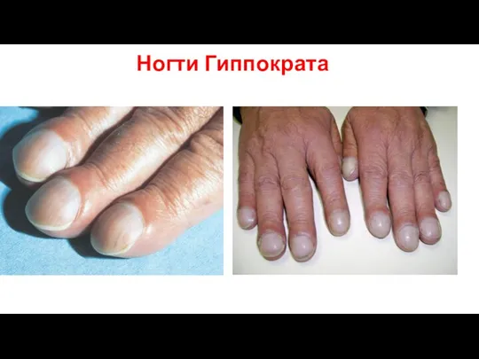 Ногти Гиппократа