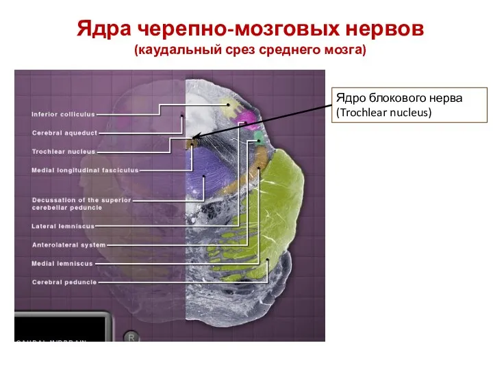 Ядра черепно-мозговых нервов (каудальный срез среднего мозга) Ядро блокового нерва (Trochlear nucleus)