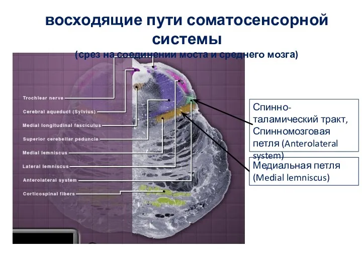 восходящие пути соматосенсорной системы (срез на соединении моста и среднего