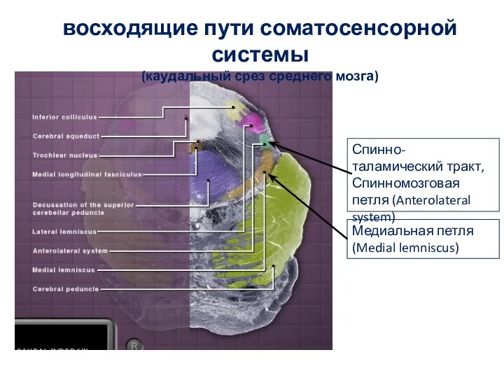 восходящие пути соматосенсорной системы (каудальный срез среднего мозга) Медиальная петля