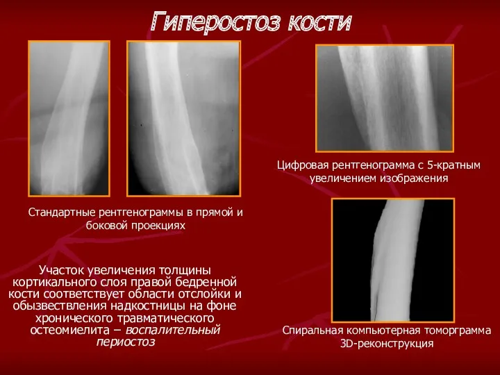 Участок увеличения толщины кортикального слоя правой бедренной кости соответствует области