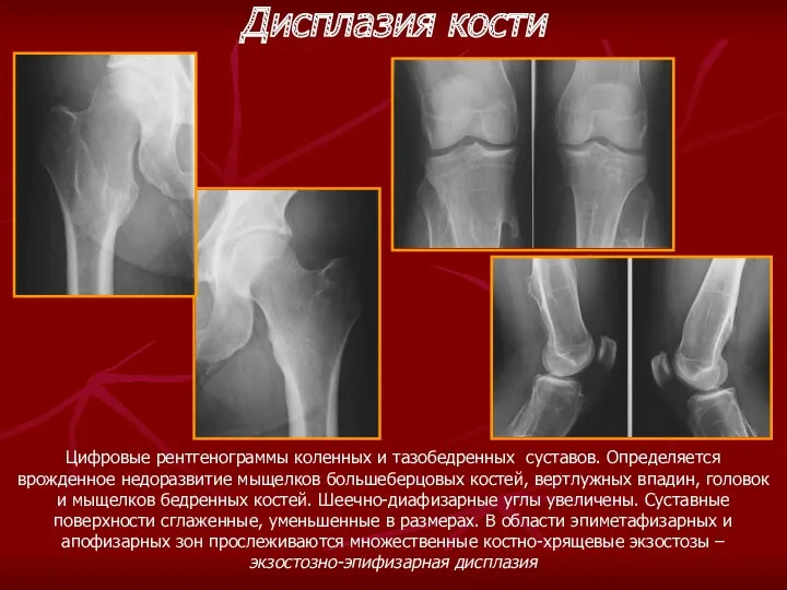 Цифровые рентгенограммы коленных и тазобедренных суставов. Определяется врожденное недоразвитие мыщелков