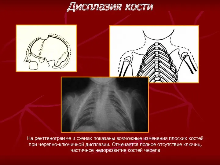 На рентгенограмме и схемах показаны возможные изменения плоских костей при