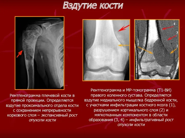 Рентгенограмма плечевой кости в прямой проекции. Определяется вздутие проксимального отдела