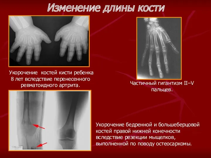 Частичный гигантизм II–V пальцев. Укорочение костей кисти ребенка 8 лет