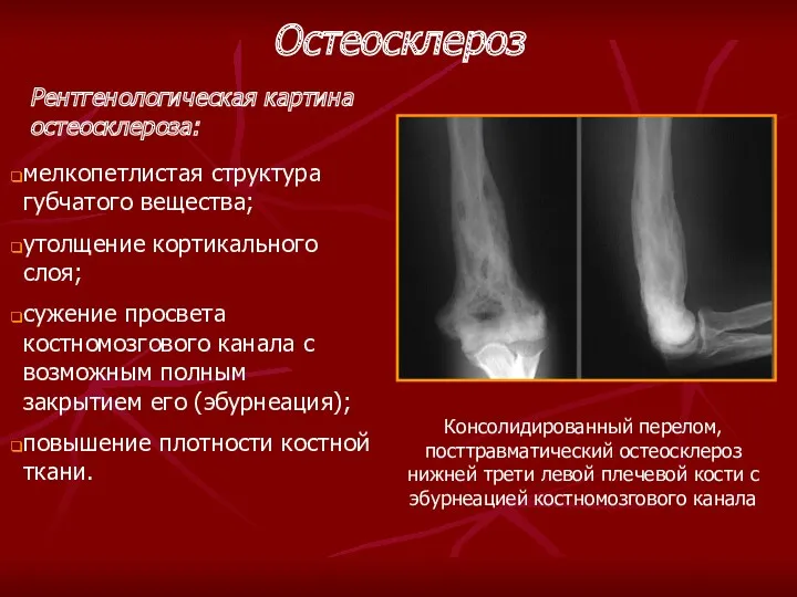Рентгенологическая картина остеосклероза: мелкопетлистая структура губчатого вещества; утолщение кортикального слоя;