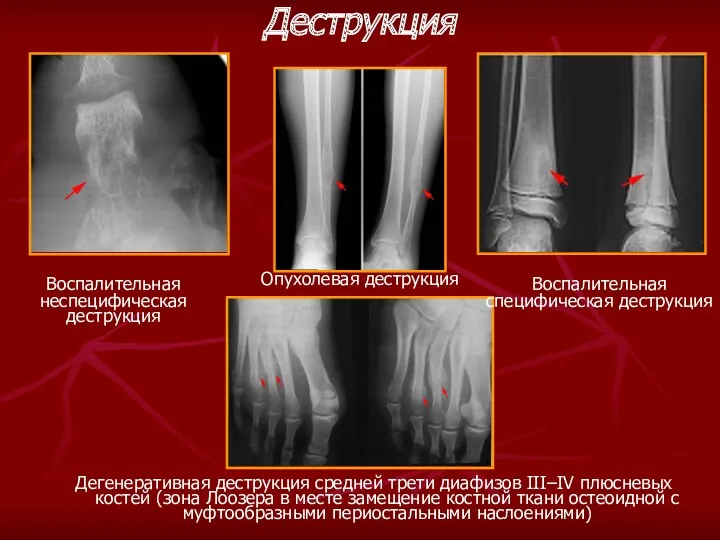 Воспалительная неспецифическая деструкция Опухолевая деструкция Дегенеративная деструкция средней трети диафизов