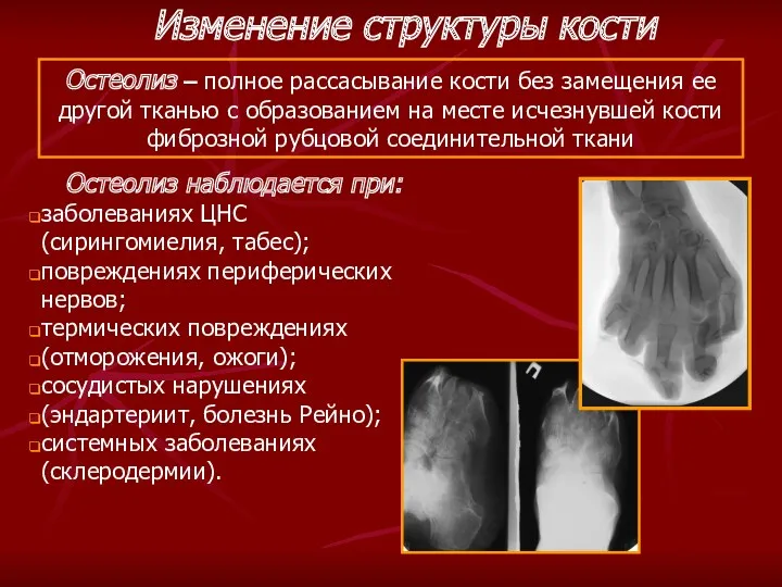 Остеолиз – полное рассасывание кости без замещения ее другой тканью