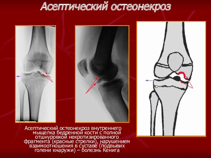 Асептический остеонекроз Асептический остеонекроз внутреннего мыщелка бедренной кости с полной