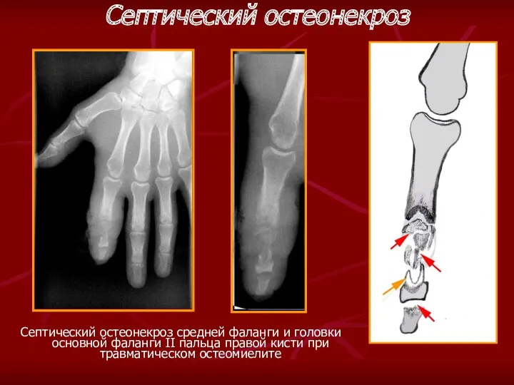 Септический остеонекроз Септический остеонекроз средней фаланги и головки основной фаланги