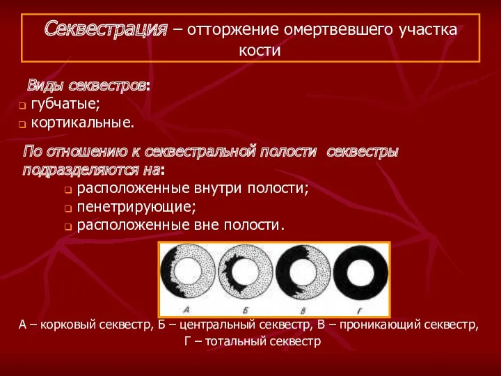 Виды секвестров: губчатые; кортикальные. Секвестрация – отторжение омертвевшего участка кости