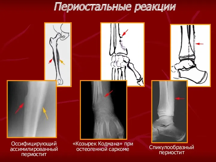 Спикулообразный периостит «Козырек Кодмана» при остеогенной саркоме Периостальные реакции Оссифицирующий ассимилированный периостит