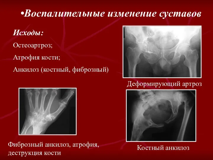 Воспалительные изменение суставов Исходы: Остеоартроз; Атрофия кости; Анкилоз (костный, фиброзный)