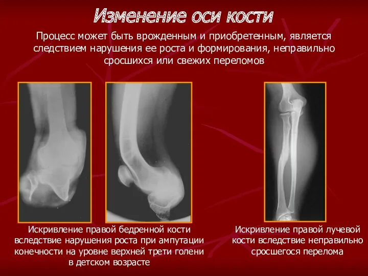 Искривление правой лучевой кости вследствие неправильно сросшегося перелома Изменение оси