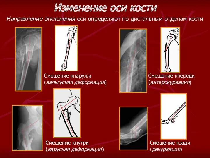 Изменение оси кости Направление отклонения оси определяют по дистальным отделам