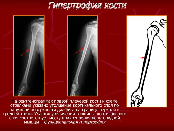 На рентгенограммах правой плечевой кости и схеме стрелками указано утолщение