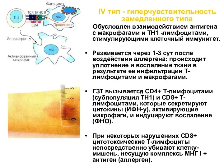 IV тип - гиперчувствительность замедленного типа Обусловлен взаимодействием антигена с