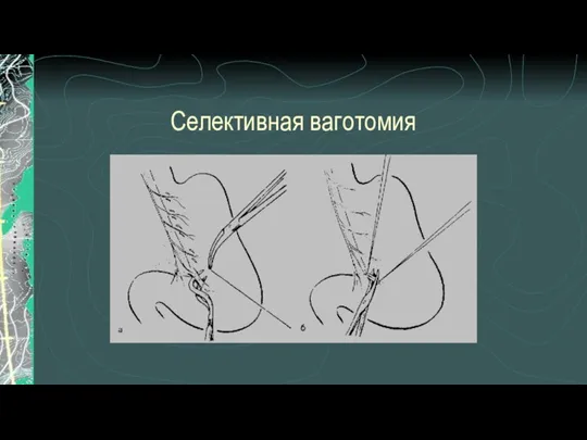 Селективная ваготомия