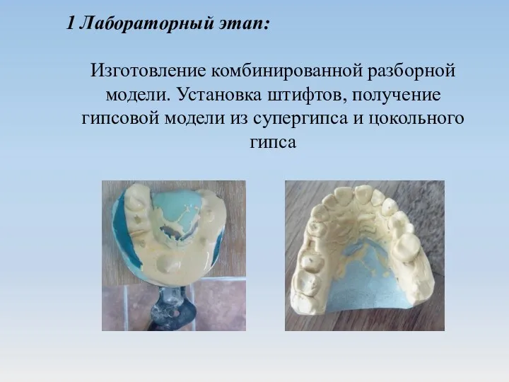 1 Лабораторный этап: Изготовление комбинированной разборной модели. Установка штифтов, получение