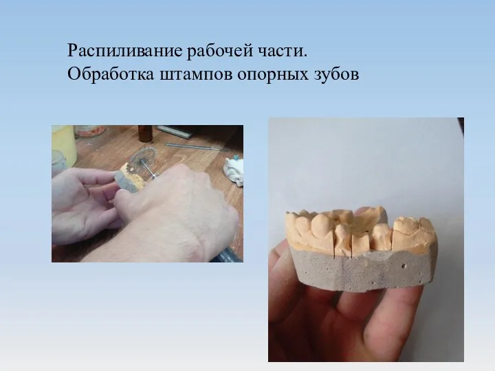 Распиливание рабочей части. Обработка штампов опорных зубов