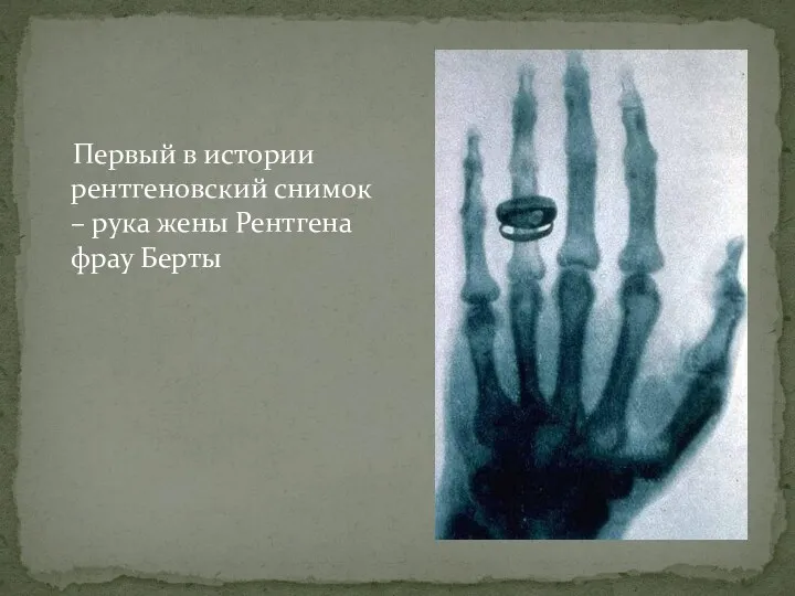 Первый в истории рентгеновский снимок – рука жены Рентгена фрау Берты